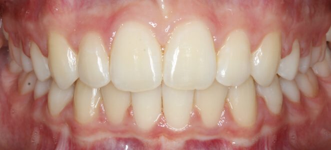 patient teeth after 14