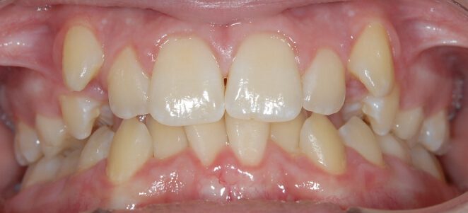 patient teeth before 10
