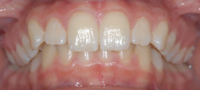 patient teeth before 11