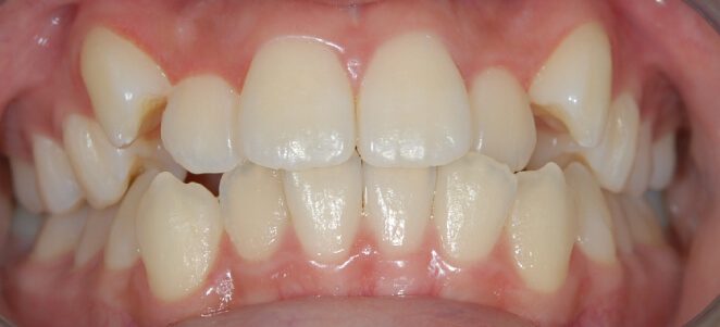 patient teeth before 12