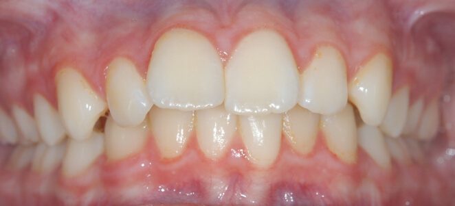 patient teeth before 13