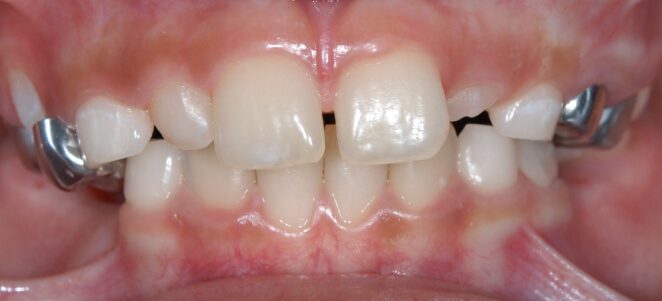 patient teeth before 2