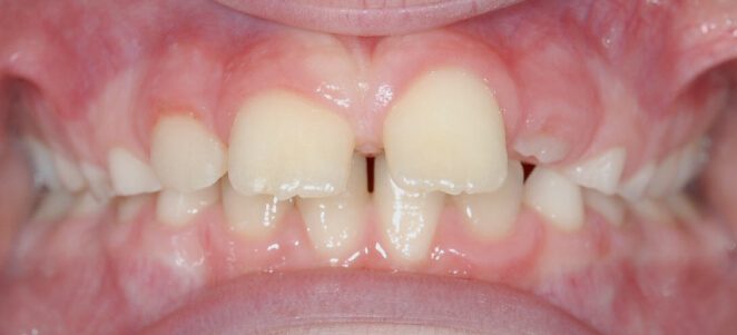 patient teeth before 4