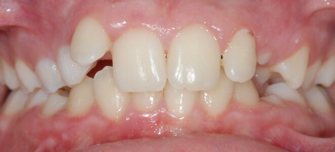 patient teeth before 5