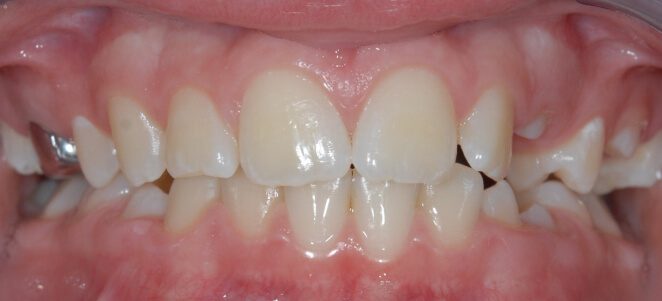 patient teeth before